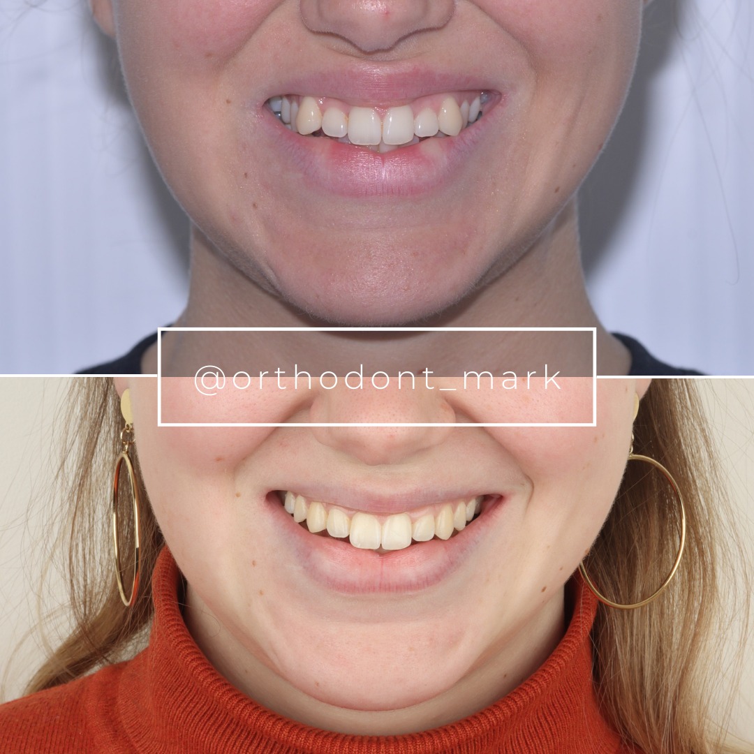 Before treatment: arch form requiring gradual expansion and alignment — photo 1 of 6