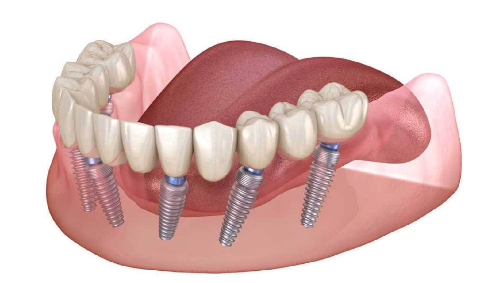 Зубные протезы рязань. All on 4 имплантация Нобель. Имплантация зубов по технологии «all on 4». Ab Dental имплантаты. На 4 имплантах all-on-4 имплантация.