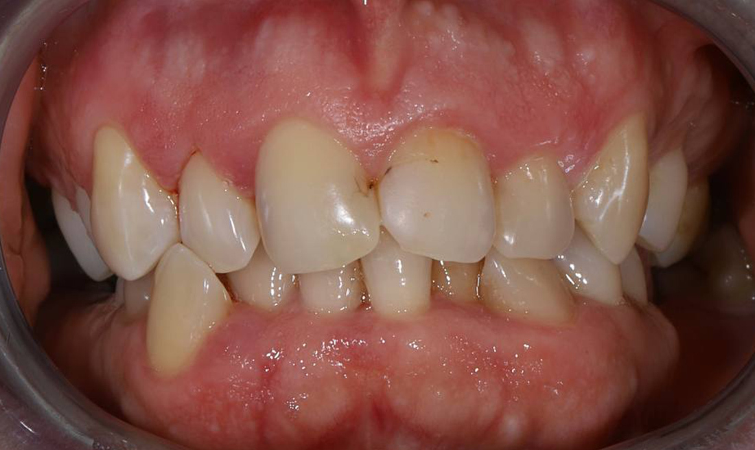 Лечение на брекет-системе с последующей ортопедической реабилитацией