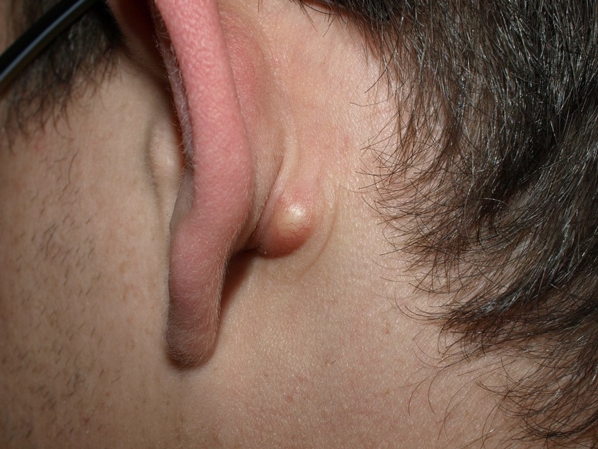 Уплотнения на мочках ушей