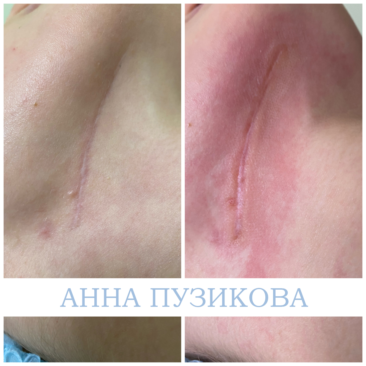 Результат удаления шрама у пациента — косметолог Пузикова Анна Анатольевна, Санкт-Петербург