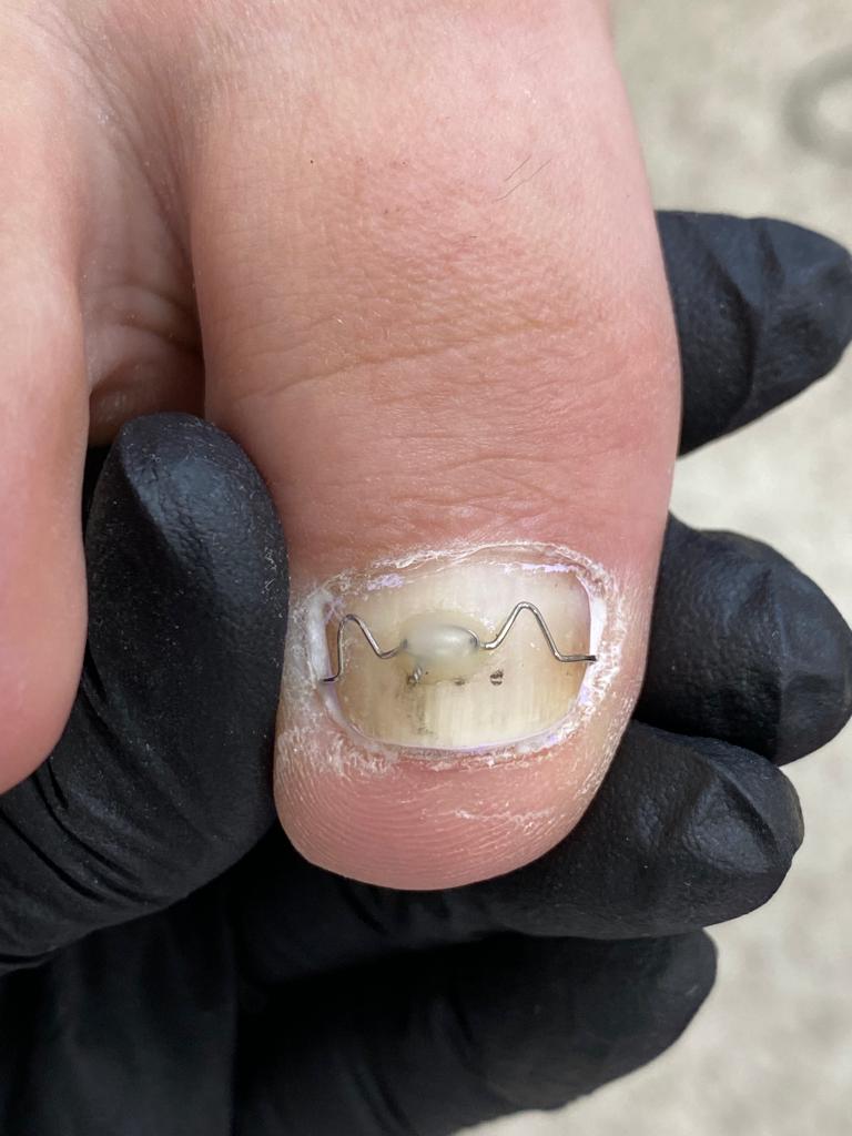 установка корректирующей системы