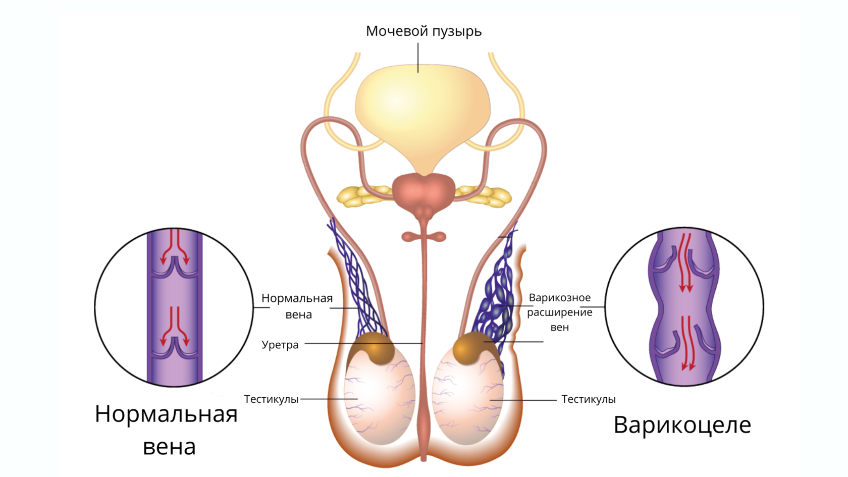 Сплетение яичка. Варикозное расширение вен яичка у мужчин. Внутренняя семенная Вена. Варикозное расширение вен семенного канатика (варикоцеле. Расширение вен мошонки.