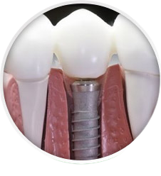 имплантация зубов цена 