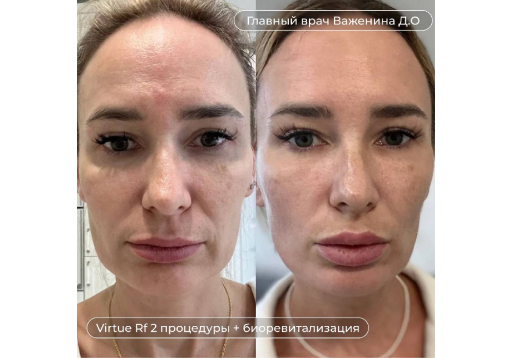 Novacutan SBio, Hyalrepair 10 и два сеанса VIRTUE