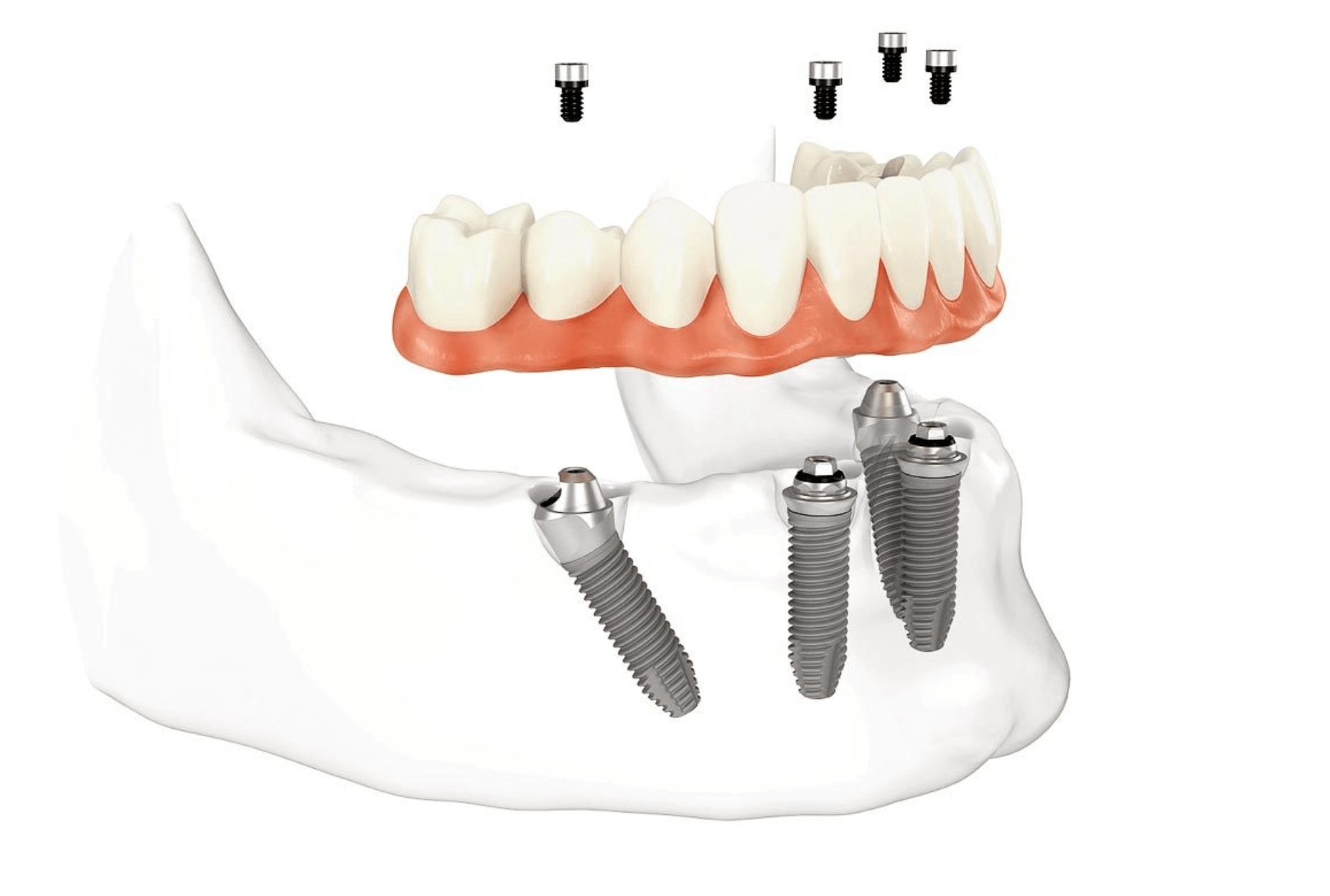 Зубы на четырех имплантах. All on 4 имплантация Нобель.