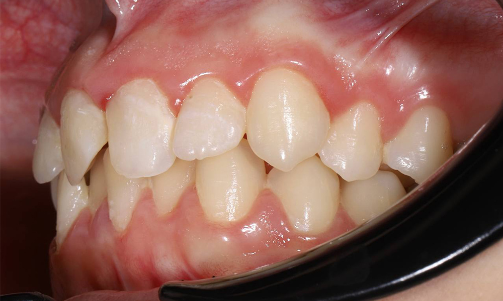 Коррекция прикуса и выравнивание зубов брекетами Experience подростку