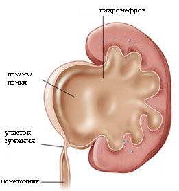 Гидронефроз почек у детей