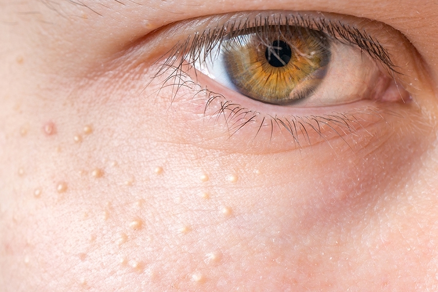 Удаление милиумов. — Полное удаление милиумов без следов — Нет покраснений, рубцов, воспалений — Кожа становится гладкой, ровной, «очищенной» — Эффект сохраняется — при правильном уходе — долгое время