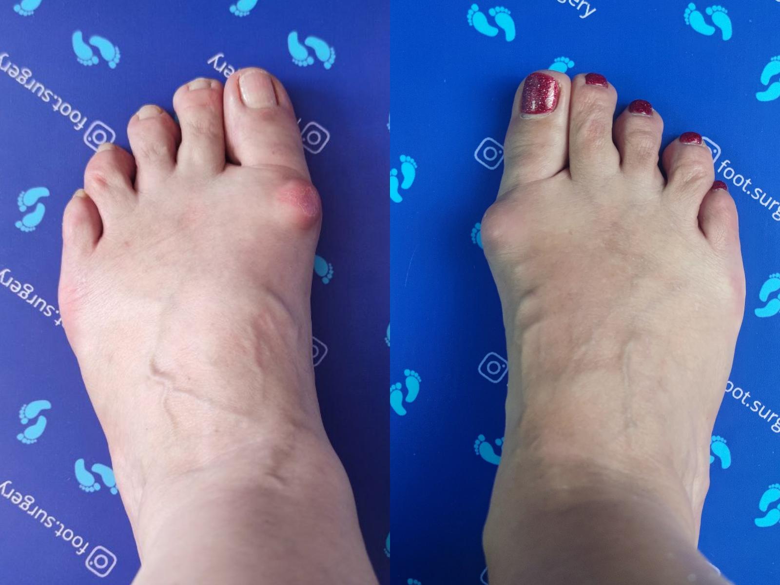 Обе стопы пациентки, 50 лет, до операции по поводу Hallux Rigidus: деформация с обеих сторон