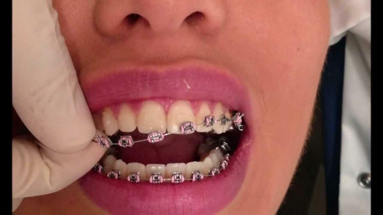 зубы за один день