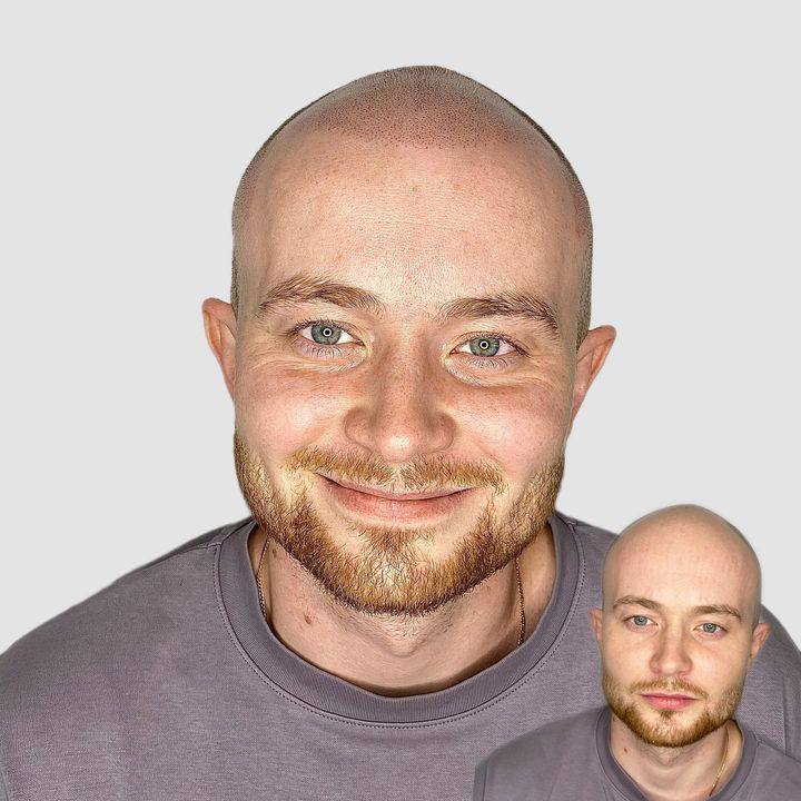 До и после процедуры трихопигментации