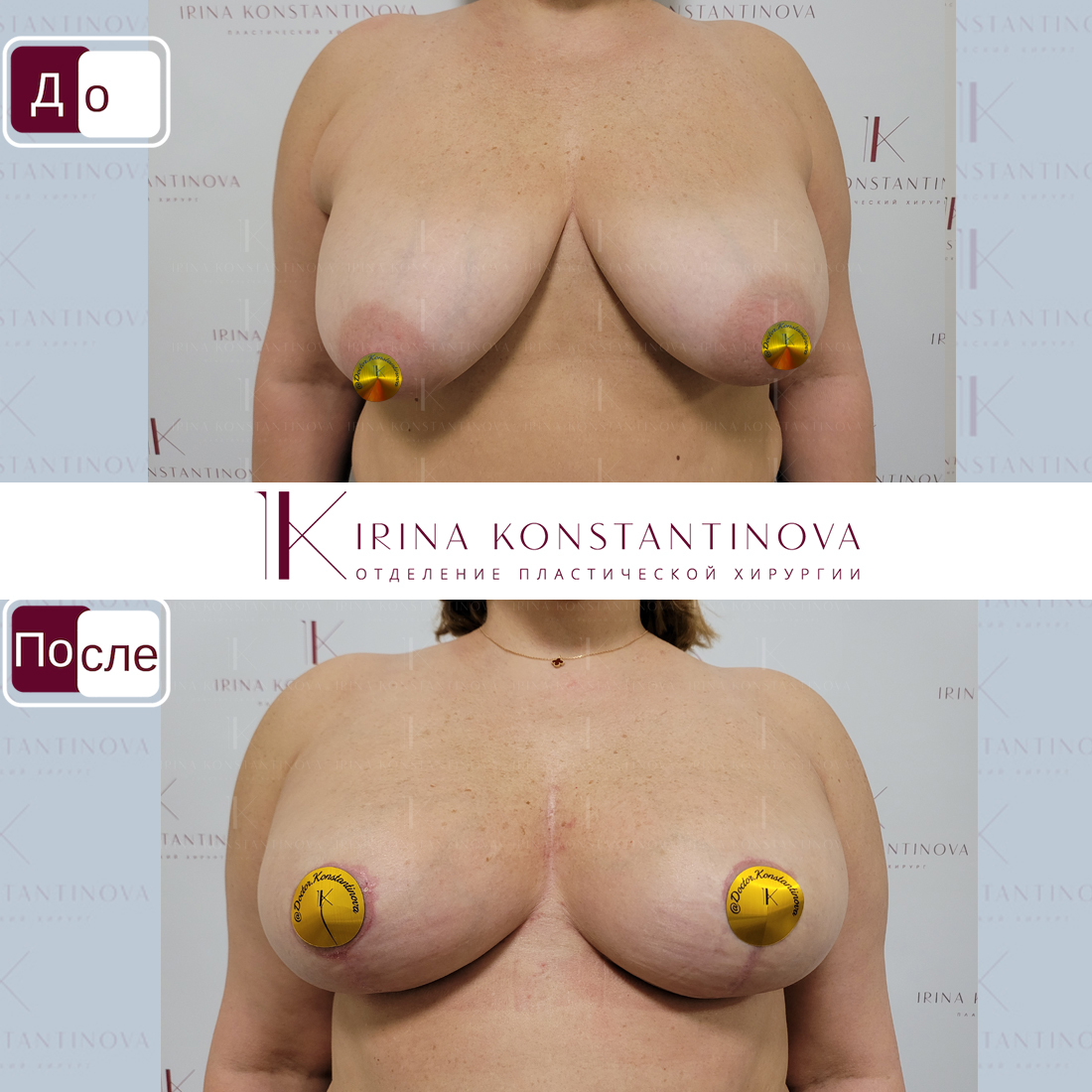крем для уменьшения груди у женщин фото 56