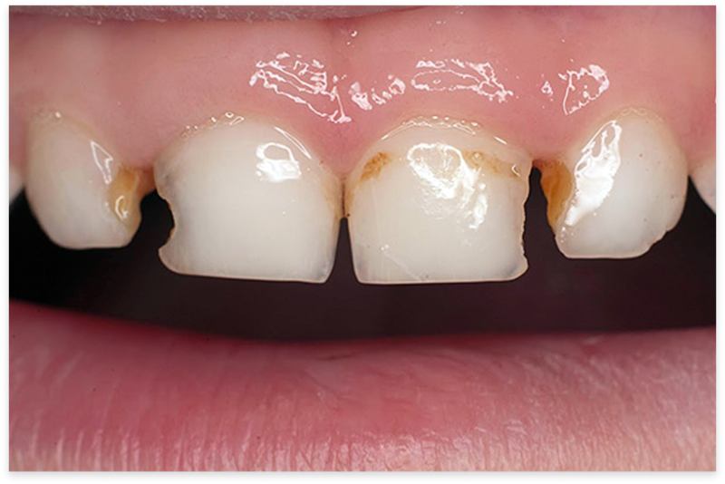 Удаление зубов у детей: показания