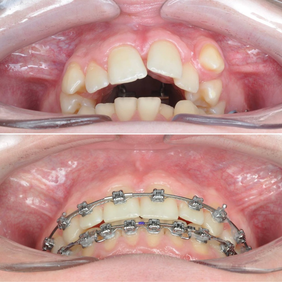 Stage progress with Damon Q2 bracket system engaged during active treatment — photo 3 of 5
