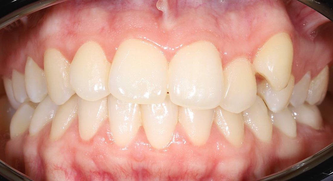 Эстетическая коррекция улыбки брекетами Damon Clear 2 совместно с Damon Q2