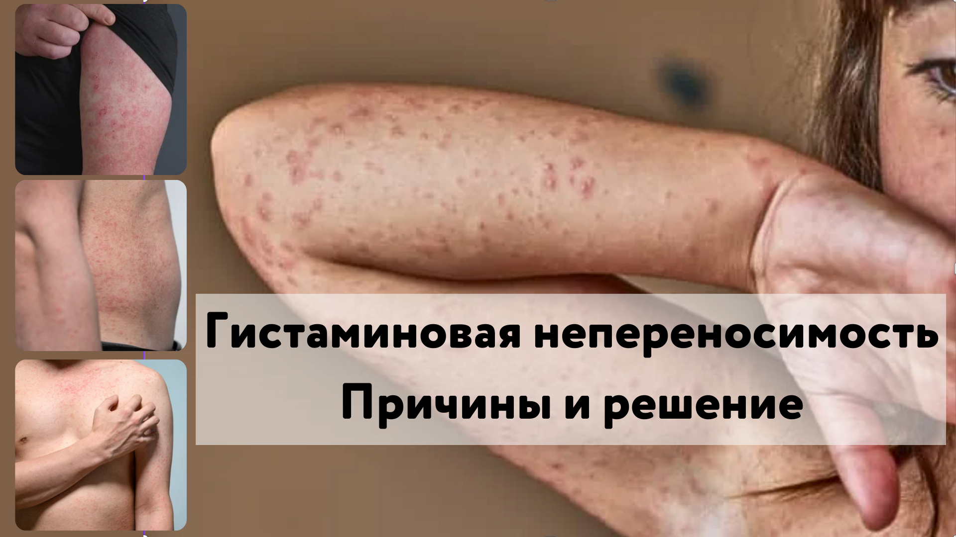 гистамин, пищевая аллергия, гистаминовая непереносимость, лекарство от аллергии, сыпь по всему телу, продукты от аллергии, питание при пищевой аллергии, лечение гистаминовой непереносимости, головные боли и мигрень, диаминоксидаза