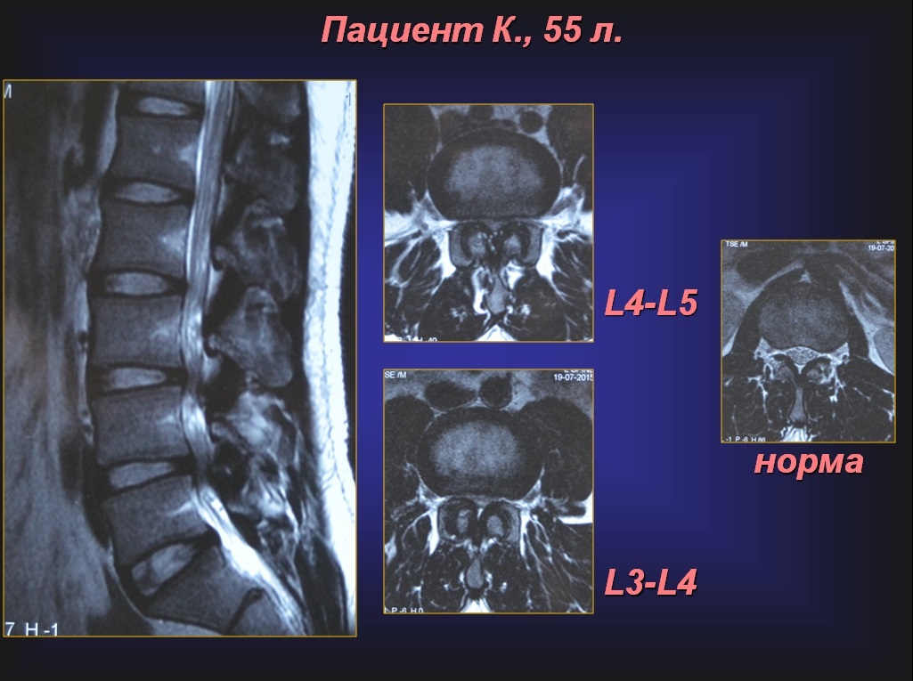 Стеноз позвоночного канала поясничного отдела в картинках