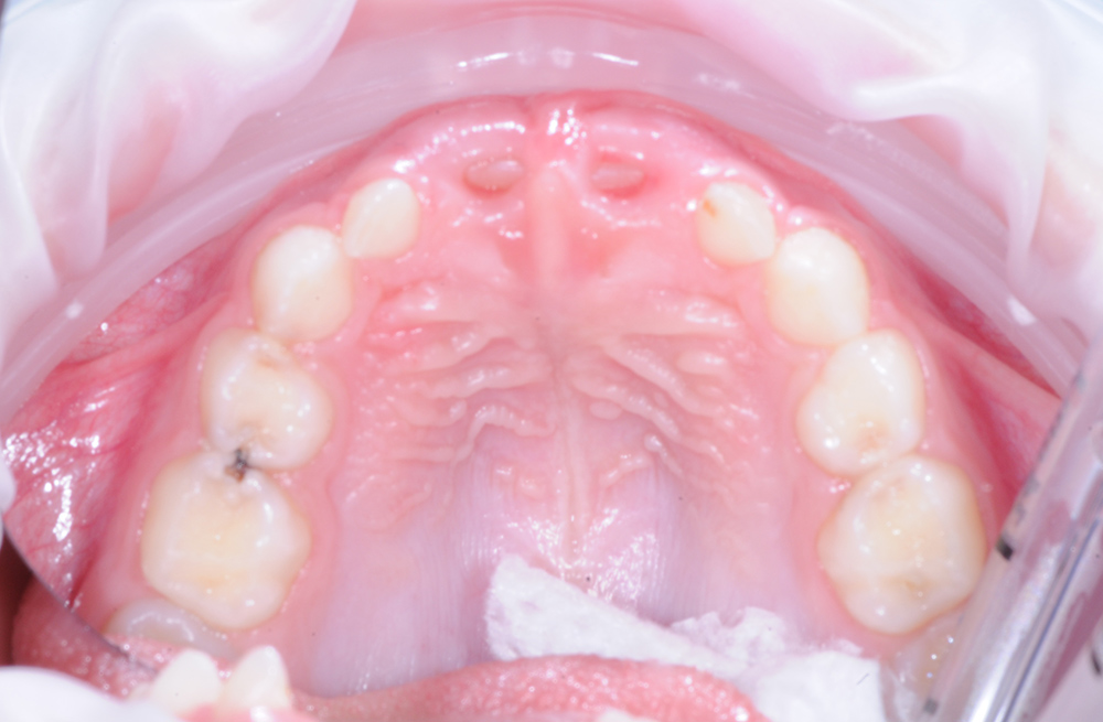 Лечение множественного кариеса и пульпита во сне у девочки 7 лет, которая боялась лечить зубы