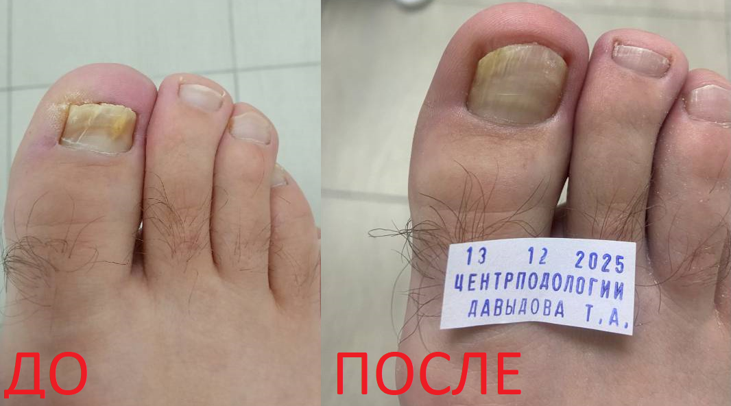 Ногти на ногах до лечения грибка и после