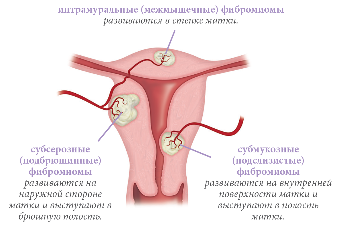 Интрамуральная миома матки что это