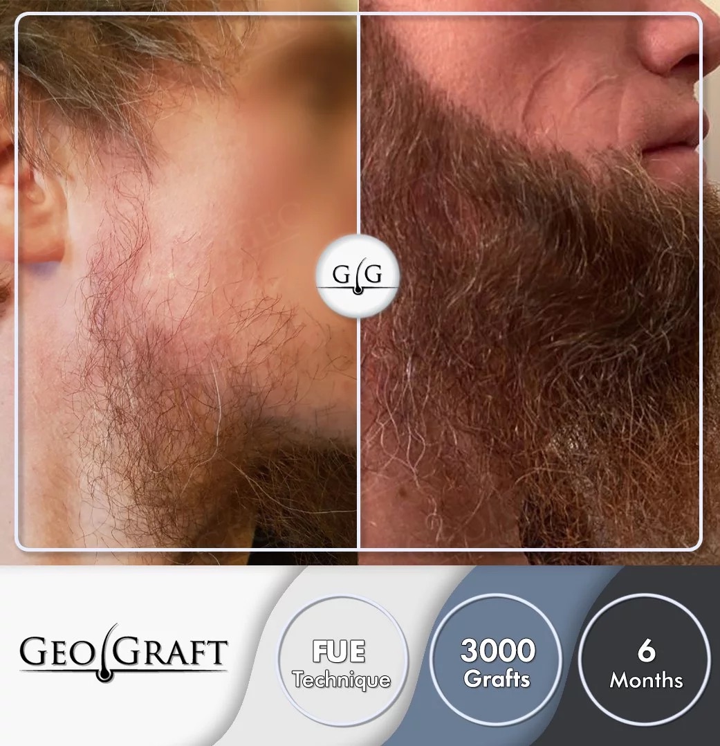 Пересадка волос в Москве. Geograft. Без боли - за один день.