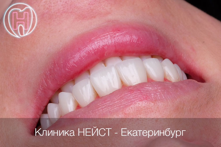 композитные виниры Премиум в Екатеринбурге, цвет Блич 4