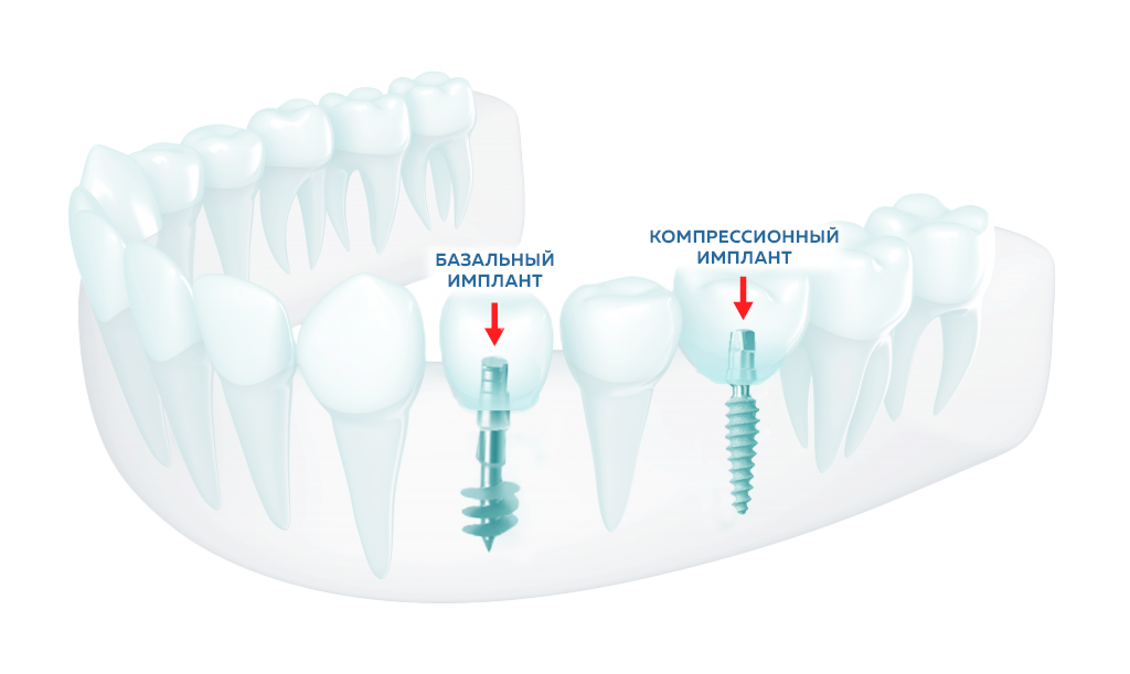 Бикортикальные имплантаты. Базальная имплантация зубов (basal Complex). BMS имплантация. ROOTT имплантация. Можно ставить импланты при диабете