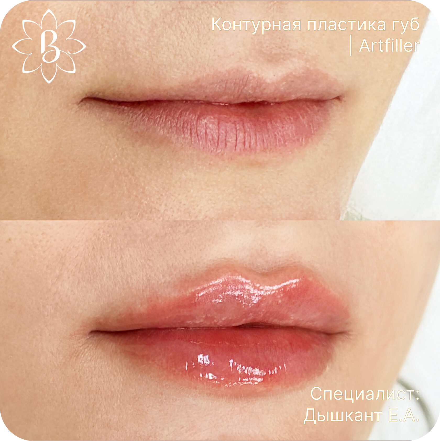 Александритовая лазерная эпиляция СПб