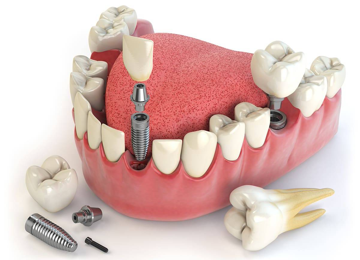 Протезирование зубов в казани. Протезы в ортопедической стоматологии. Стоматология имплантация.