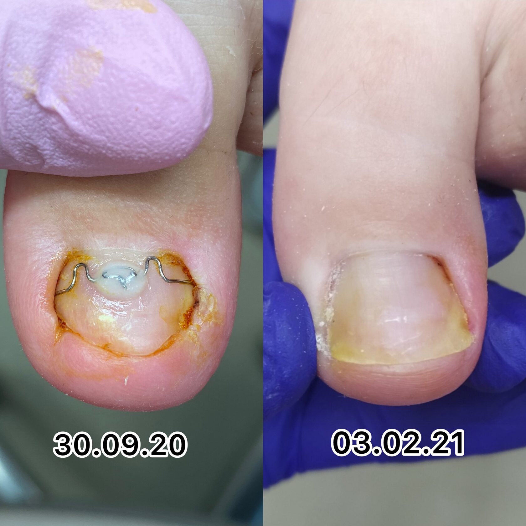 Лечение и удаление вросшего ногтя в Перми без боли по доступной цене ...