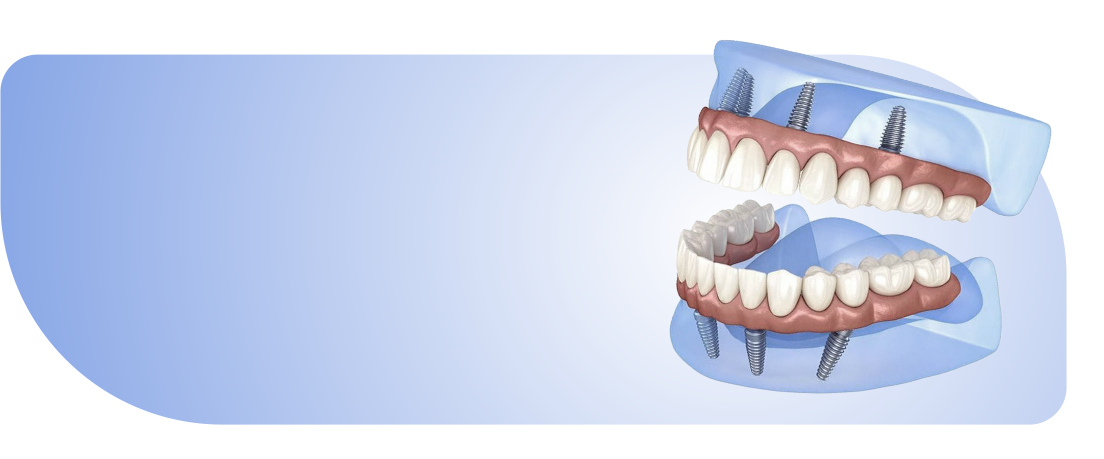 Имплантация и протезирование в Сургуте. Имплантация все на 6. All in 4, All in 6.