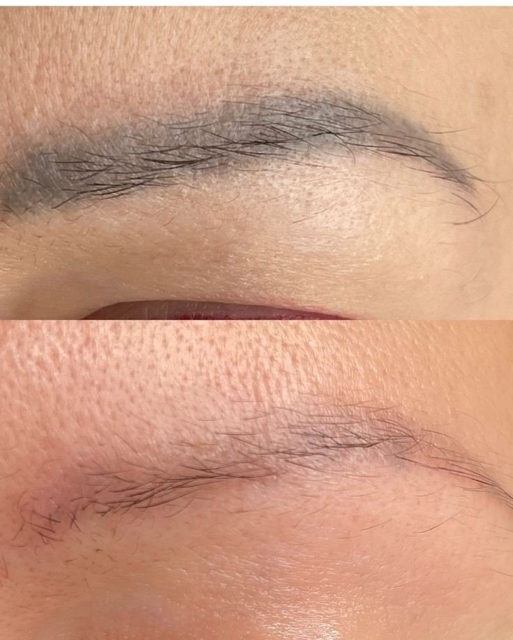 Удаление татуажа бровей