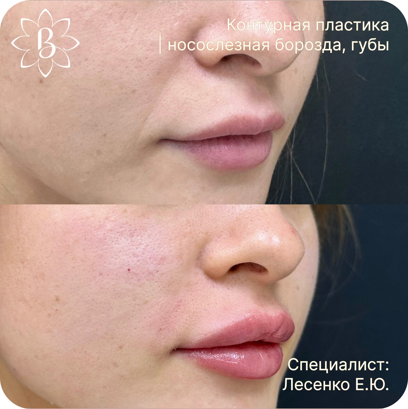 Александритовая лазерная эпиляция