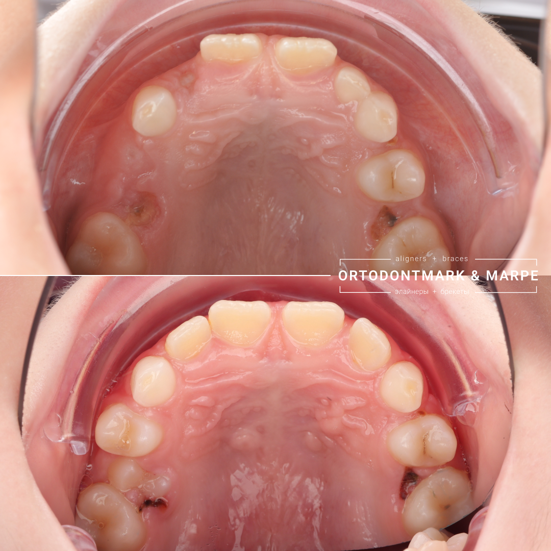 MARPE case result 7