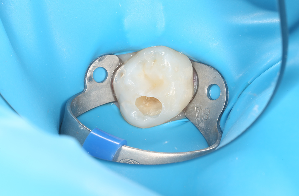 Преимущество ранней диагностики в лечении кариеса молочного зуба у ребёнка до появления боли