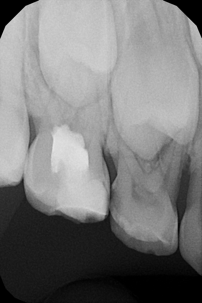 Лечение межзубного кариеса у ребёнка с последующим восстановлением анатомической формы зубов