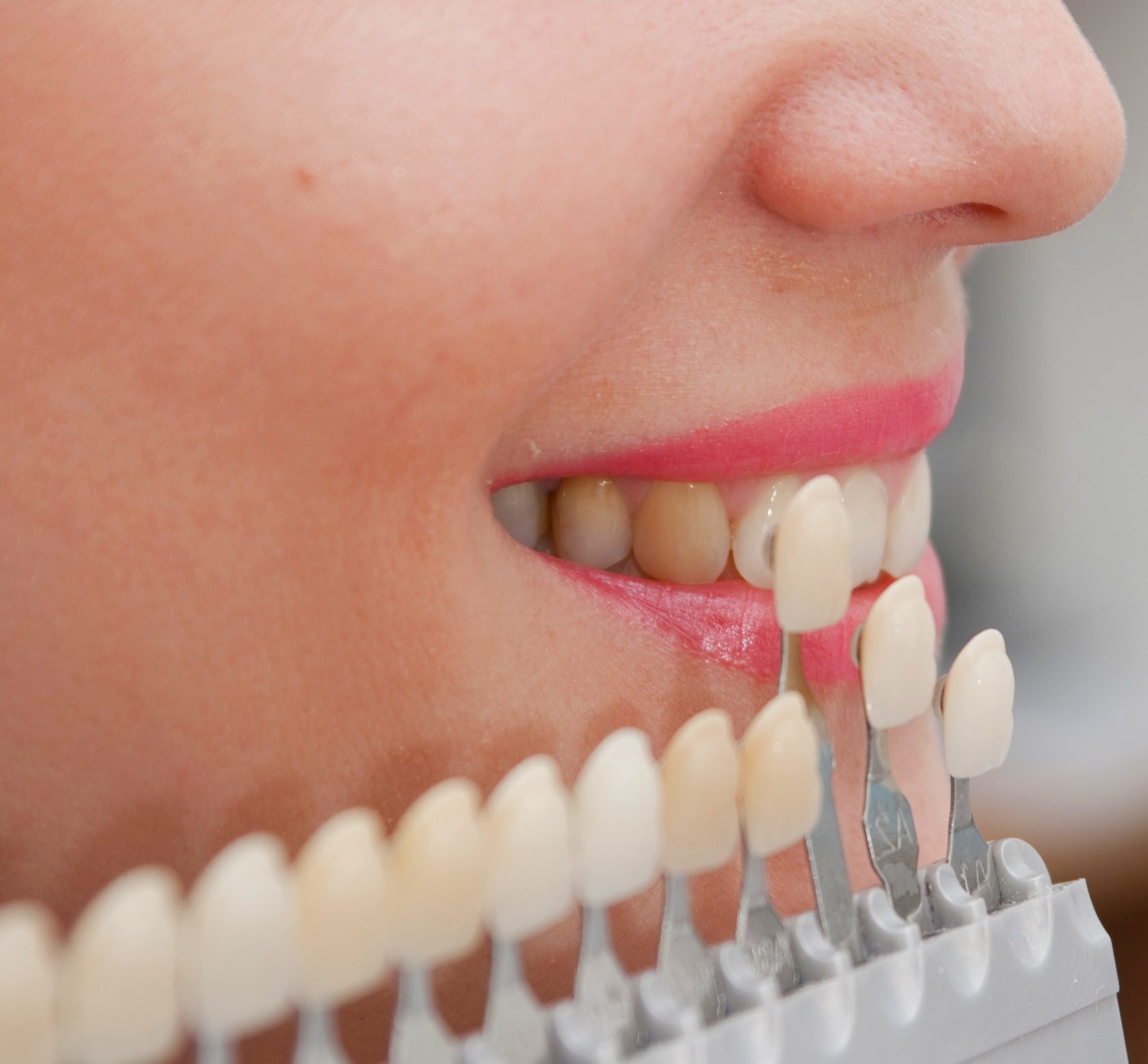 Как исправить неправильный прикус и неровные зубы у взрослых