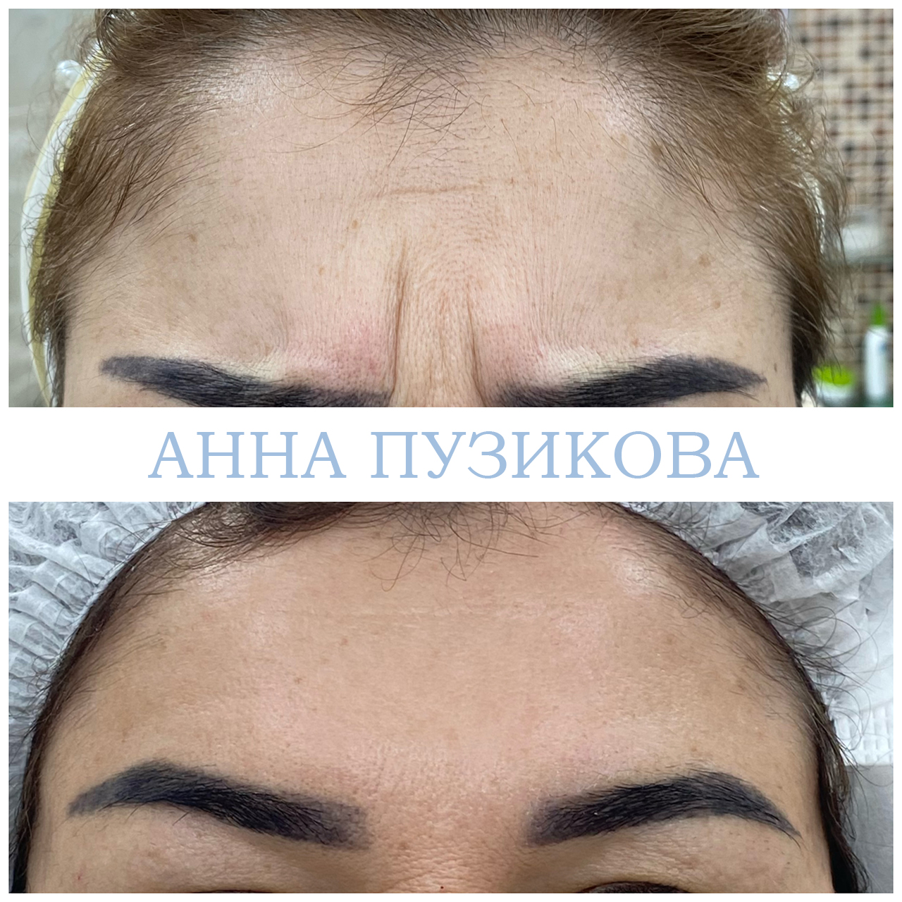 Результат ботулинотерапии — коррекция мимических морщин на лбу и в области глаз. Косметолог Пузикова Анна Анатольевна, Санкт-Петербург
