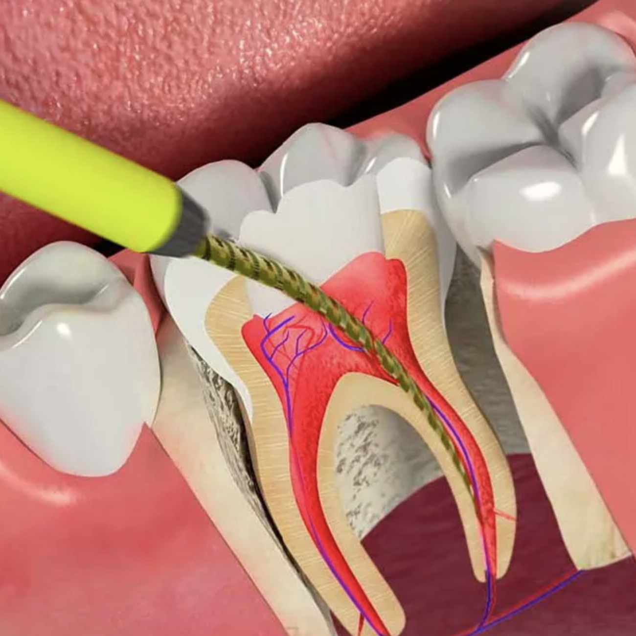 Эндодонтия в стоматологии. Временное пломбирование корневых