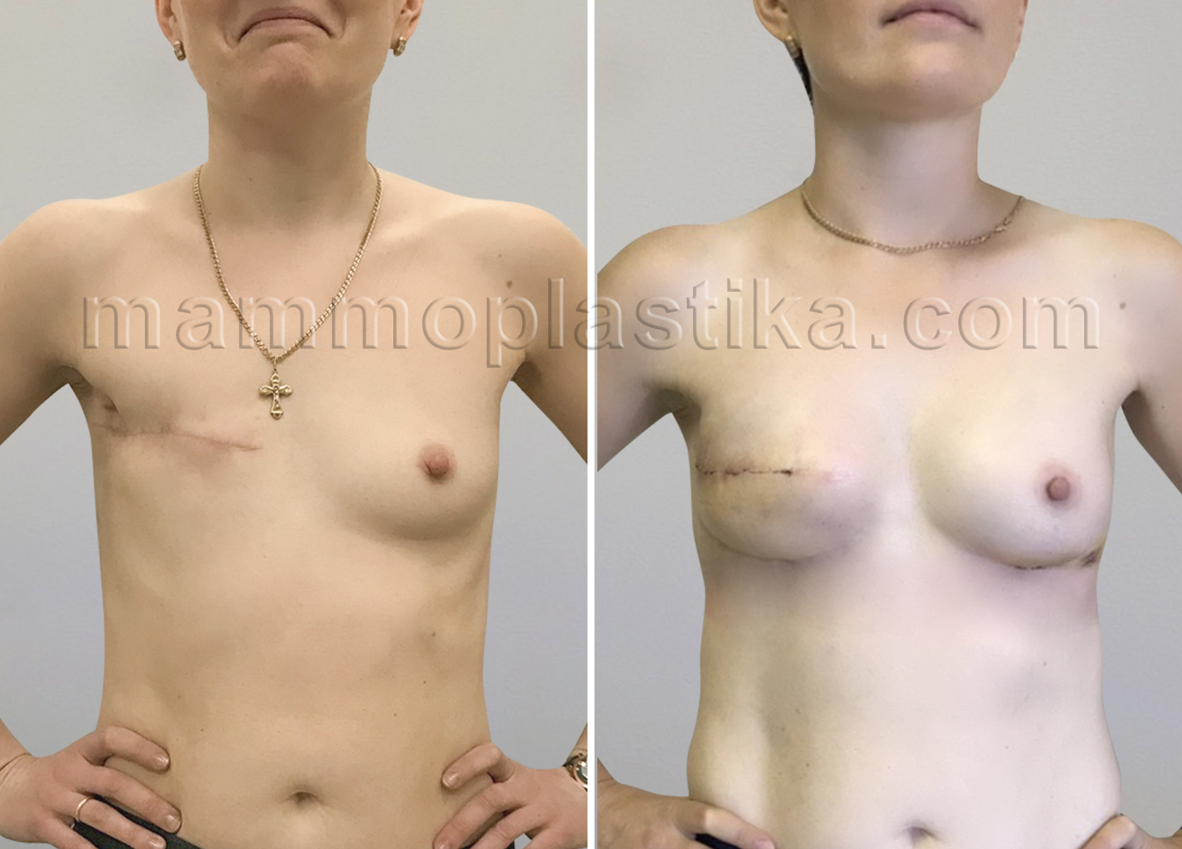 операция по удалению груди у женщин фото 113