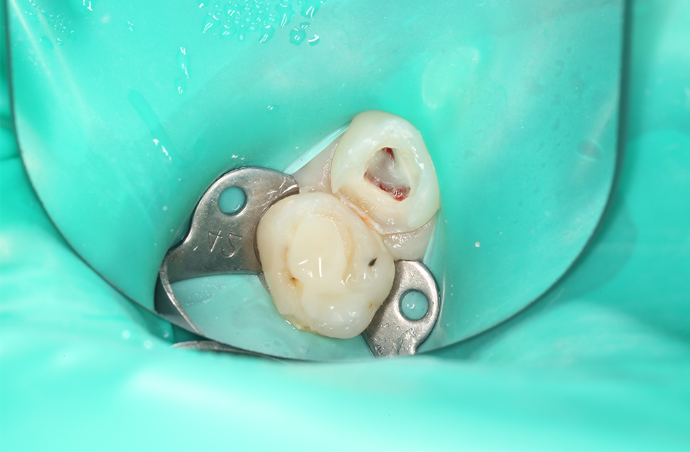 Лечение осложнённого кариеса молочного зуба в условиях ЗАКС и протезирование коронкой