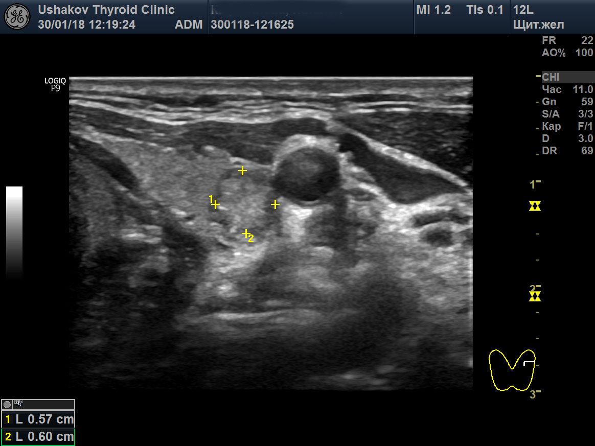 Узел гиперплазии щитовидной железы. Аденома паращитовидных желез на УЗИ. Узел паращитовидной железы на УЗИ.