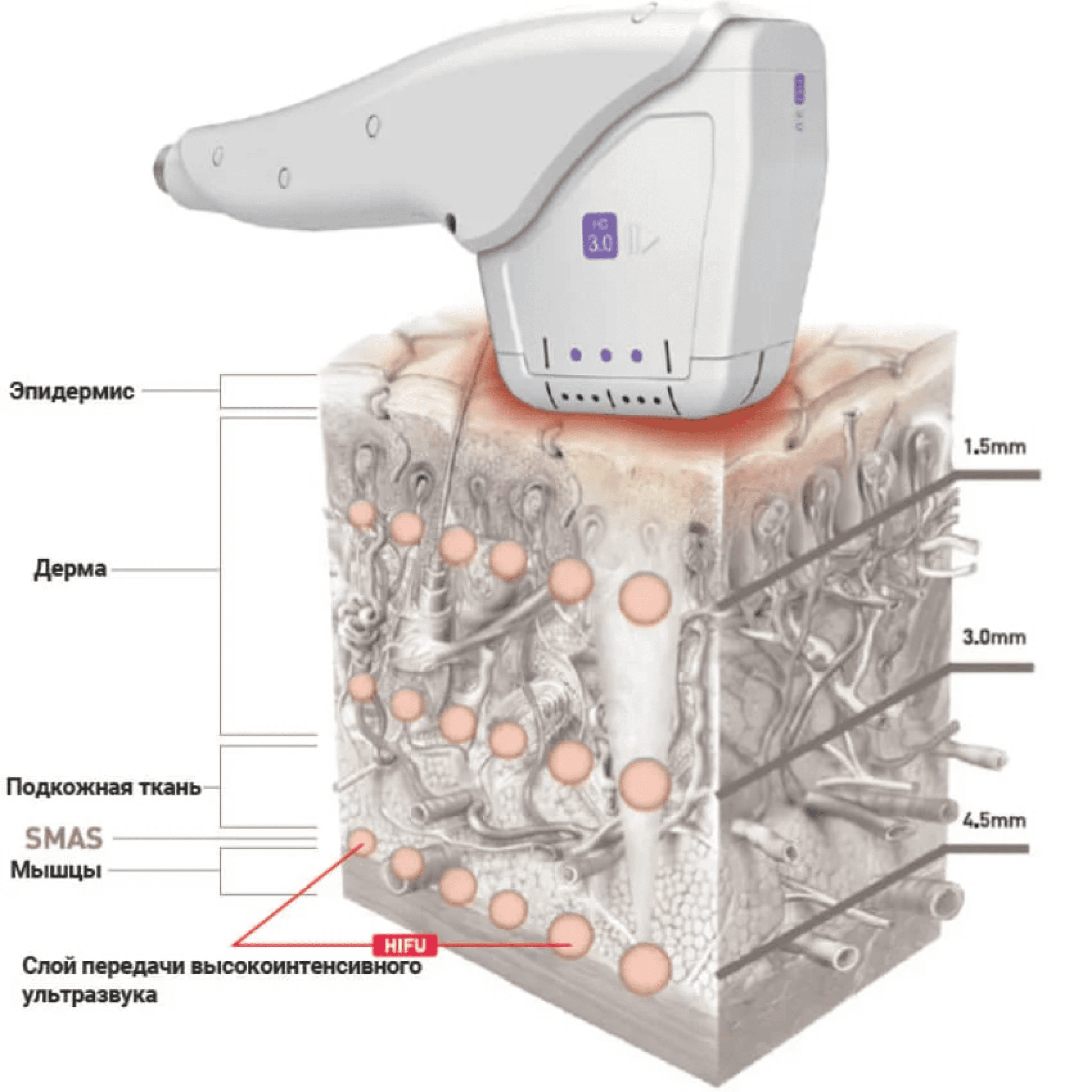 Hifu ультразвук. Аппарат smas HIFU Ultrasound. Smas 4d HIFU / High intensity Focused Ultrasound картридж. HIFU 4d смас лифтинг. HIFU smas лифтинг Корея.