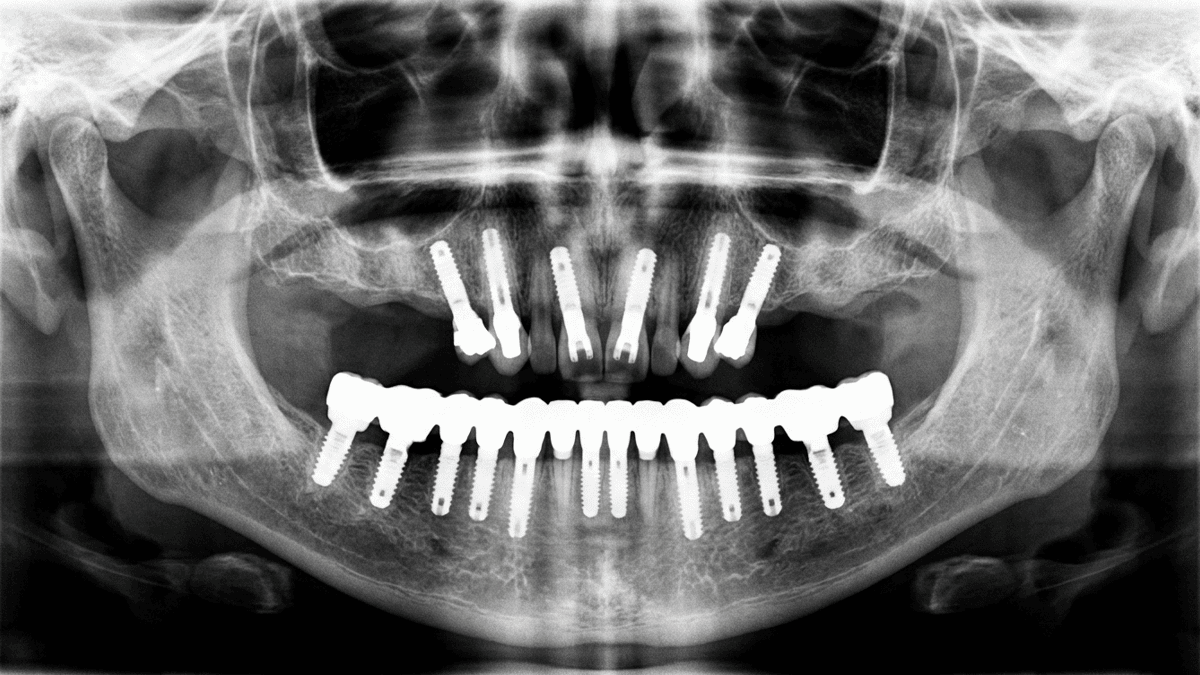 Птеригоидные импланты