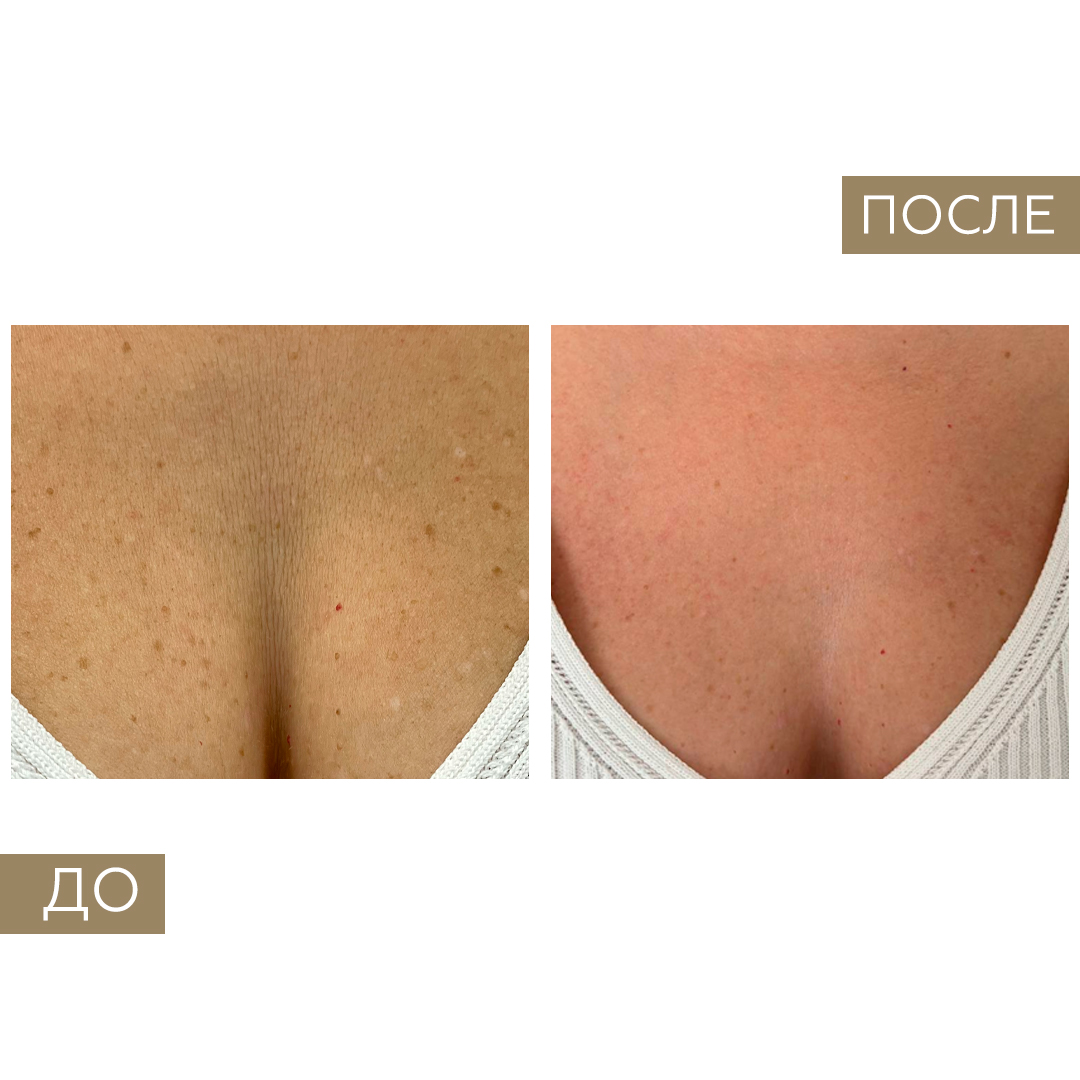 Кожа до и после курса биоревитализации в клинике BeautyPLAN
