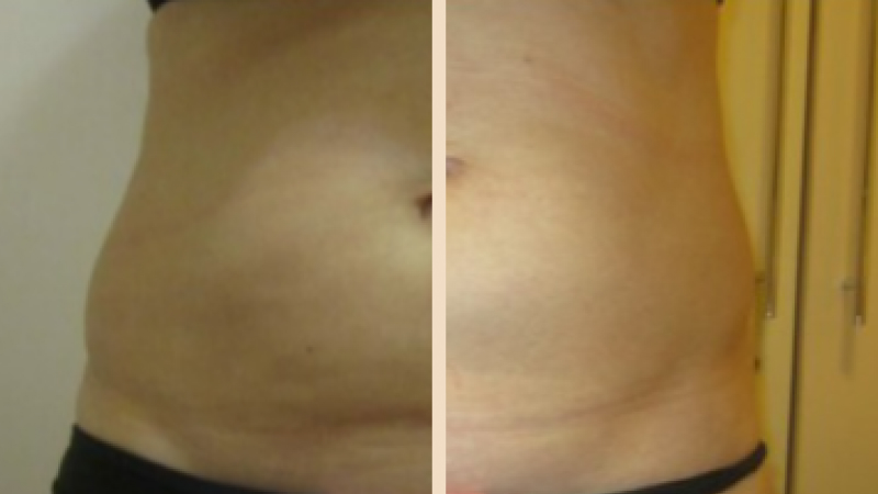 Криолиполиз Zeltiq в Новосибирске : цены, отзывы, фото до и после ...