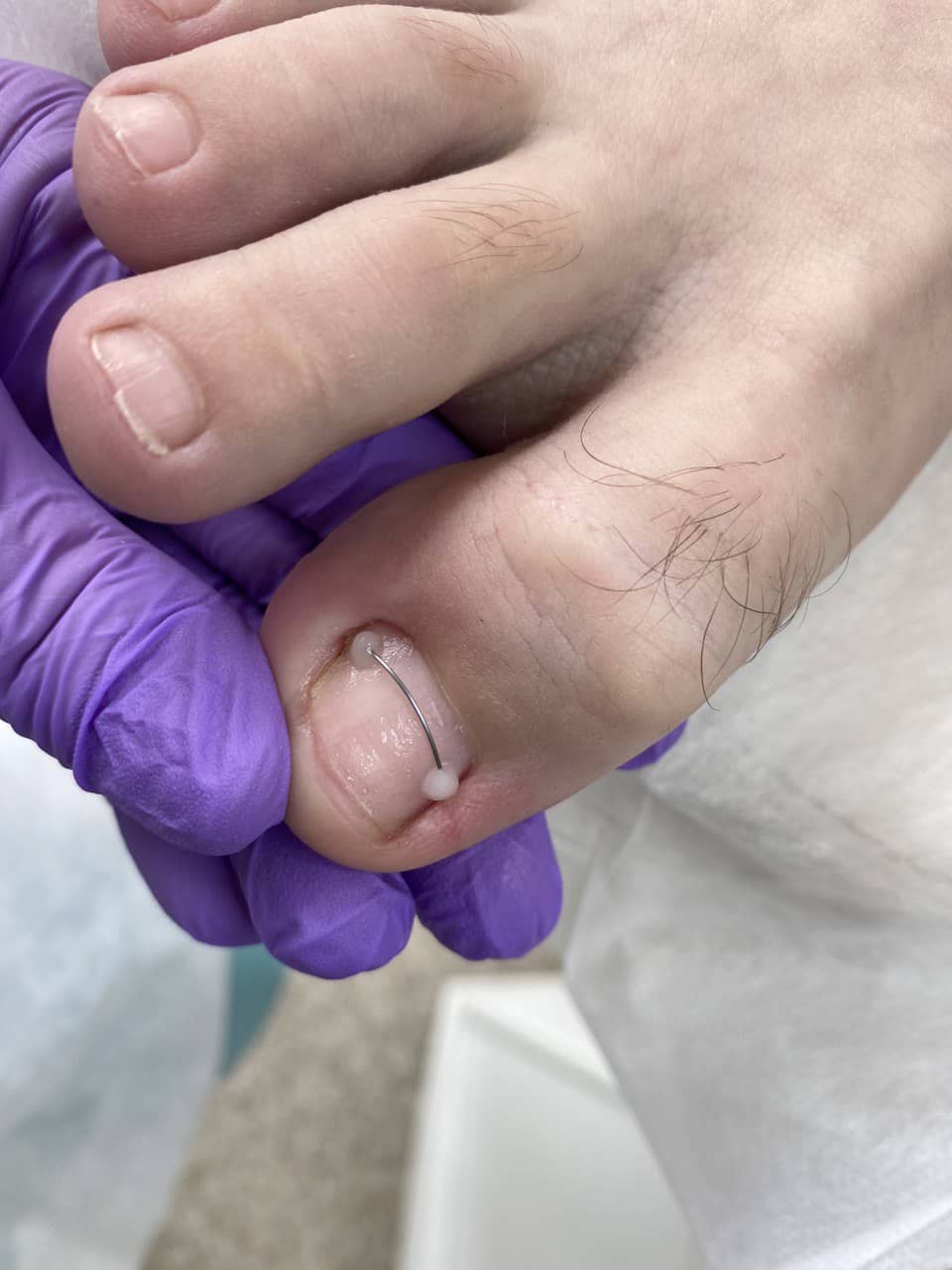 Титановая нить в процессе