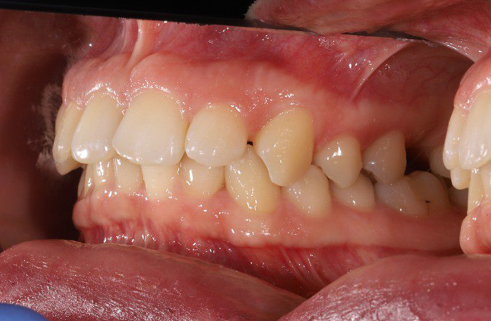 Реабилитация зубного ряда после удаления зуба, пораженного периодонтитом,с помощью синус-лифтинга и имплантации