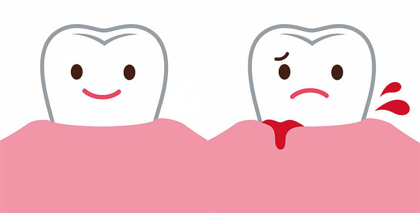 Кровоточат десны: как лечить – стоматология ПрезиДЕНТ
